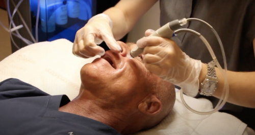 Dr. Mitchel Goldman is getting a HydraFacial in San Diego, CA.