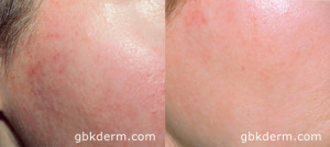 before and after image of chemical peel results from medical spa in San Diego