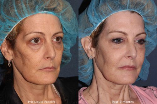 before and after of patient who received a combination of cosmetic treatments from our dermatologists in San Diego