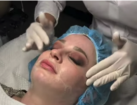 patient receiving a dermaplaning skin exfoliation treatment in san diego, ca