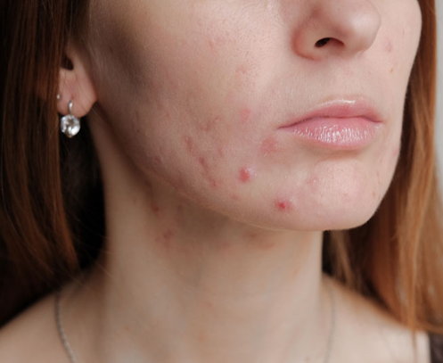 Stock image of a woman with acne on her face, San Diego, CA.