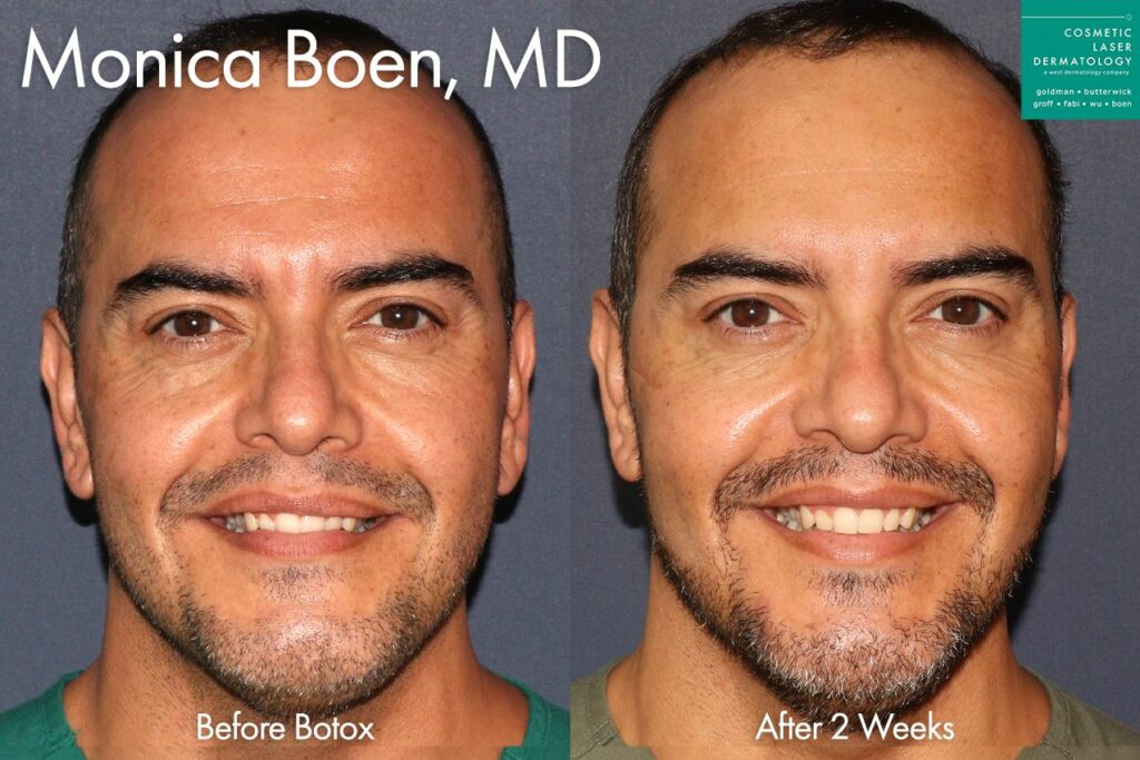 Botox to treat facial wrinkles by Dr. Boen. Disclaimer: Results may vary from patient to patient. Results are not guaranteed.