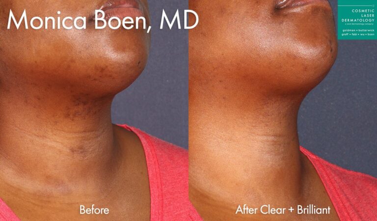Clear + Brilliant laser to treat brown spots on chin and neck by Dr. Boen. After treatment, spots are reduced and skin looks clearer.