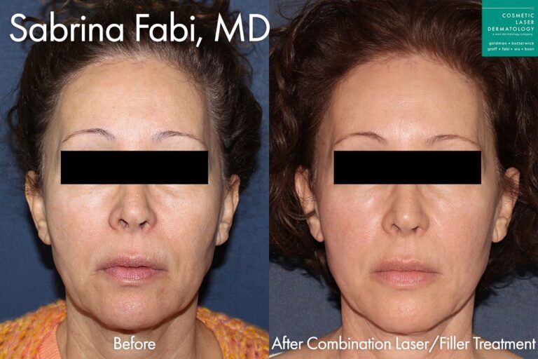 Combination of laser and filler treatments for full skin rejuvenation by Dr. Fabi. After treatment, patient's skin is firmer, smoother, and more youthful.