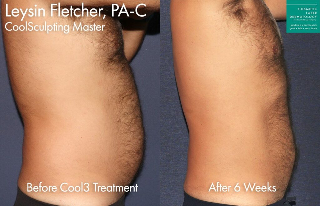 CoolSculpting Elite and CoolTone to sculpt the abdomen by Leysin Fletcher, PA-C. Disclaimer: Results may vary from patient to patient. Results are not guaranteed.