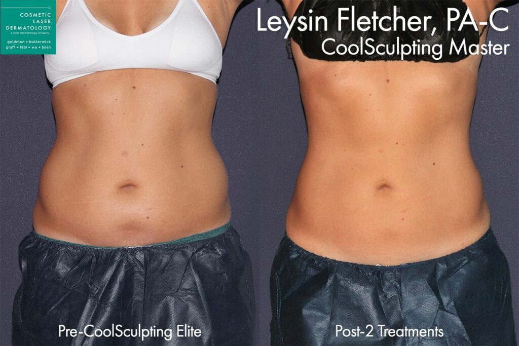 CoolSculpting Elite Before and After  New Treatment + Better Results —  Emerson Medical