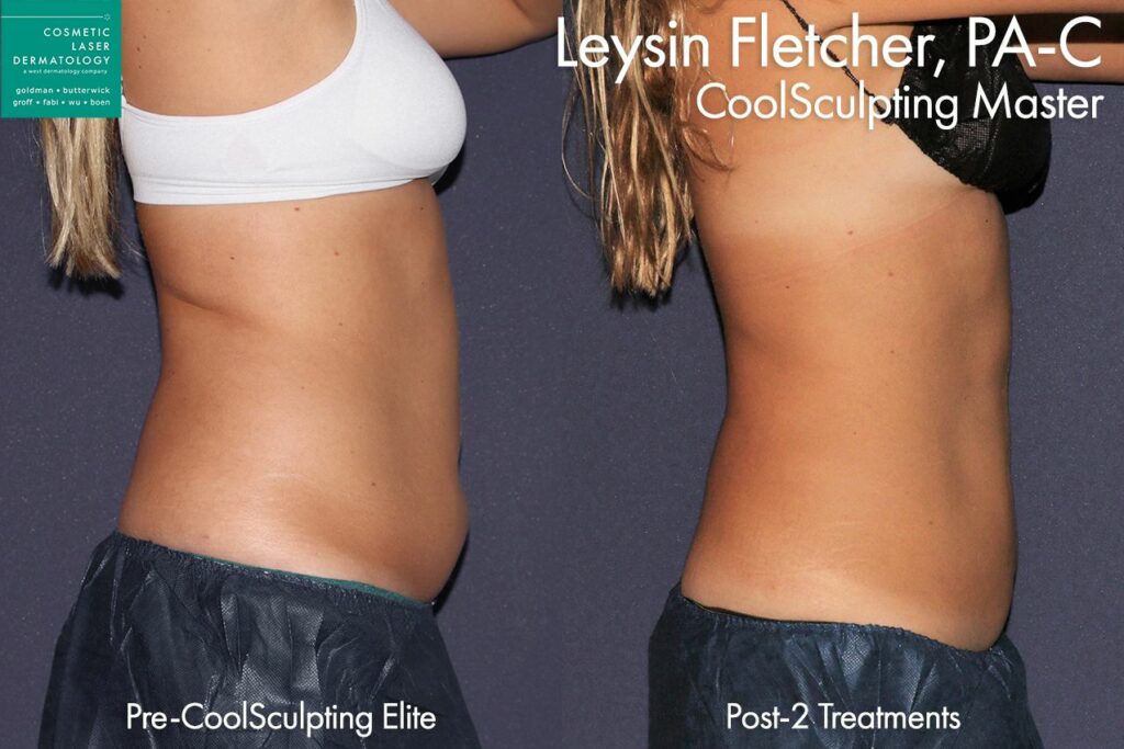 CoolSculpting® Elite Before & After Photos Patient 105, Boston, MA