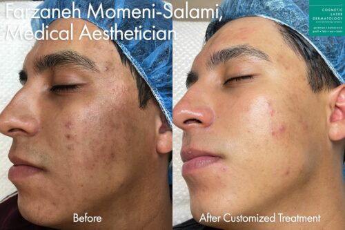 Custom acne treatment to minimize breakouts by Farzaneh. After treatment, skin is clearer and smoother.