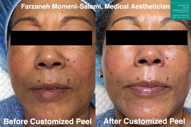 Custom peel for skin rejuvenation by Farzaneh. After treatment, skin is smoother and brighter.