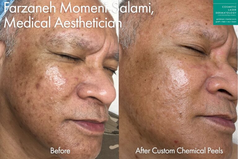 Custom peel for skin rejuvenation by Farzaneh. After treatment, skin is smoother and brighter.