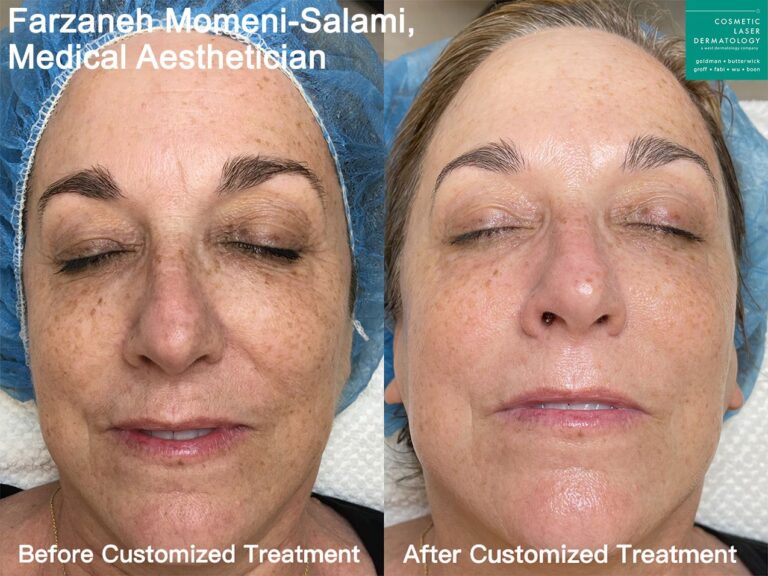 Custom treatment to address sun damage by Farzaneh. After treatment, skin has a more even skin tone and is brighter.