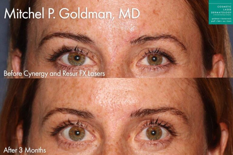 Cynergy and ResurFX lasers to treat forehead scar by Dr. Goldman. After treatment, scar is no longer noticeable.
