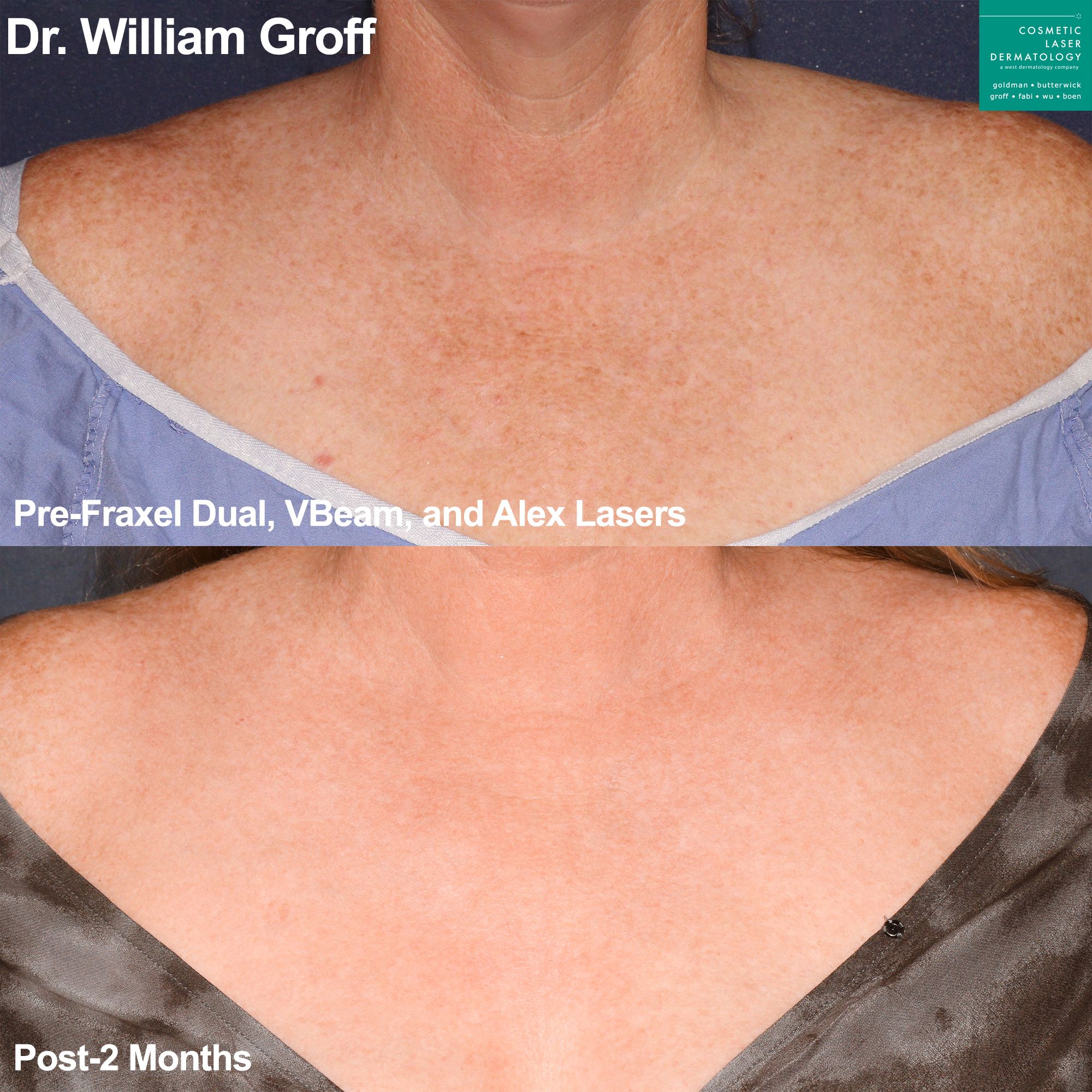 NonAblative Laser Resurfacing for Sun Damage How It Can Help Repair