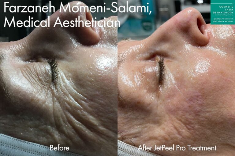 JetPeel to reduce deep creases around the eyes by Farzaneh. Treatment creates smoother, more youthful skin.