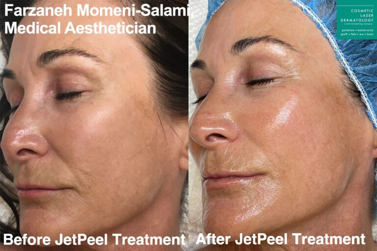 JetPeel for full face rejuvenation by Farzaneh. After treatment, skin looks smoother and more hydrated.