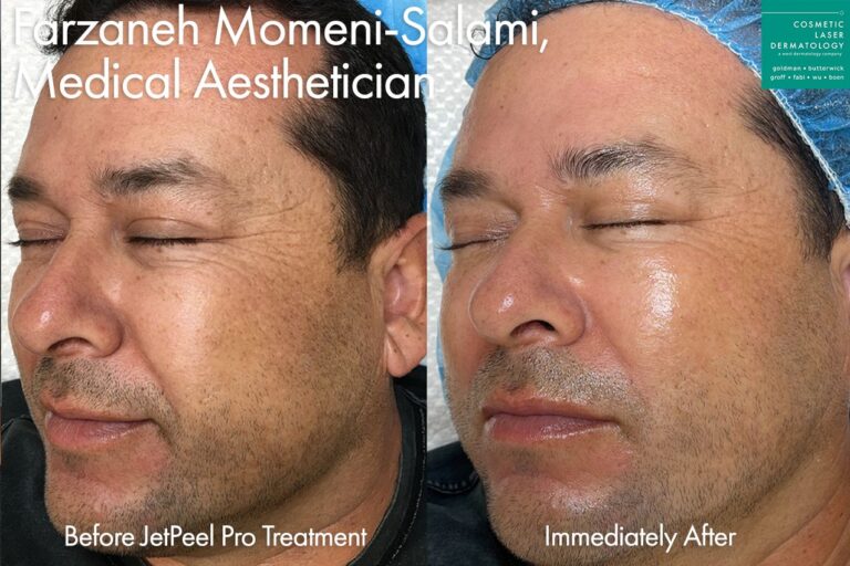 JetPeel for full face rejuvenation by Farzaneh. After treatment, skin looks smoother and more hydrated.
