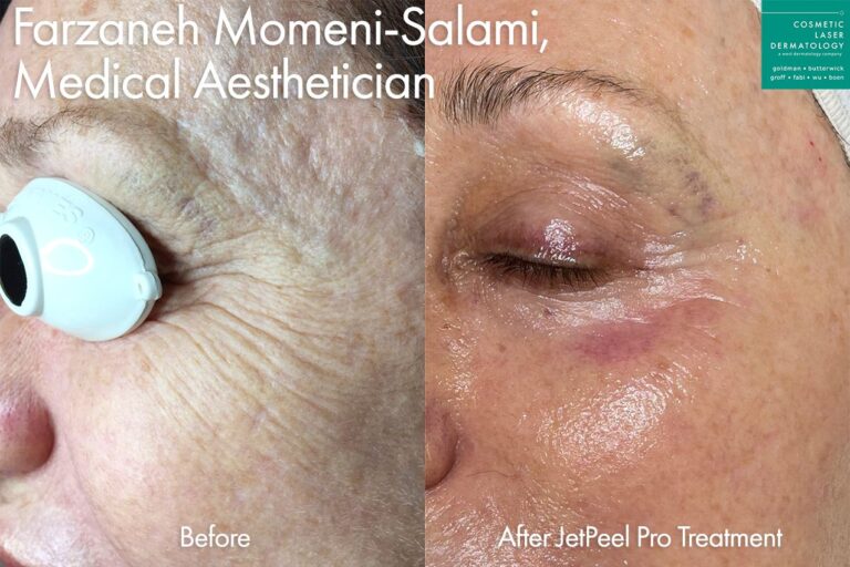 JetPeel to reduce lines around the eyes by Farzaneh. After treatment, skin is smoother with a visible reduction in wrinkles.