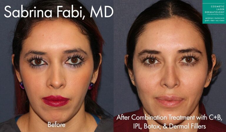 Combination of fillers and lasers for full skin rejuvenation by Dr. Fabi. After treatment, patient looks refreshed and more youthful.
