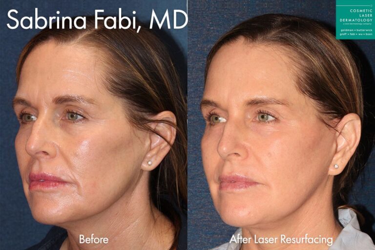 Laser resurfacing for skin rejuvenation by Dr. Fabi. Treatment leaves skin smoother and more vibrant with a visible reduction in fine lines and wrinkles.