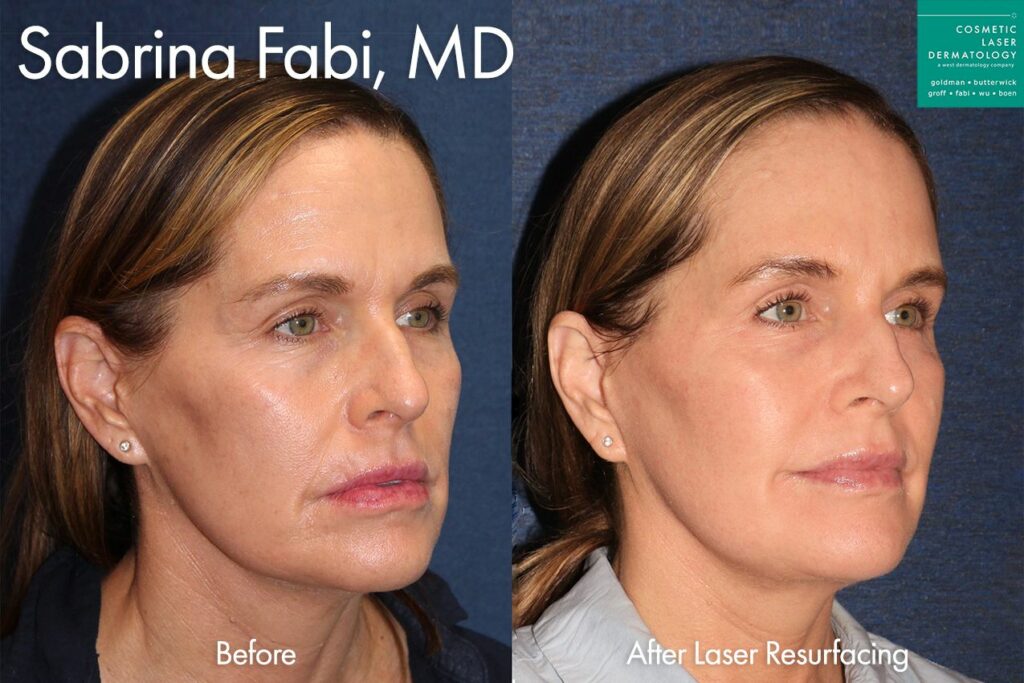 Laser resurfacing for skin rejuvenation by Dr. Fabi. Disclaimer: Results may vary from patient to patient. Results are not guaranteed.