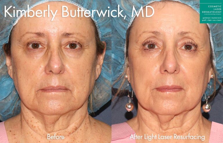 Light laser resurfacing for skin rejuvenation by Dr. Butterwick, After treatment, skin is smoother and fine lines are reduced.