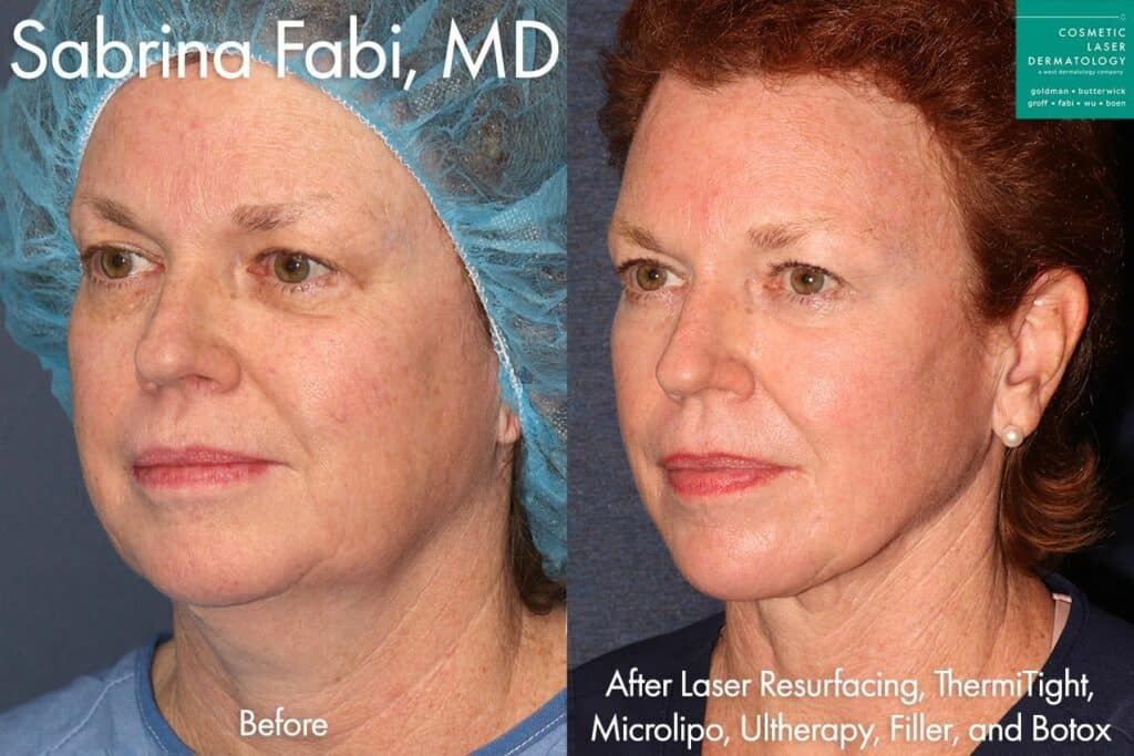 Laser Resurfacing, Micro Lipo, ThermiTight, Ultherapy, Fillers, and Botox for full rejuvenation by Dr. Fabi. Disclaimer: Results may vary from patient to patient. Results are not guaranteed.