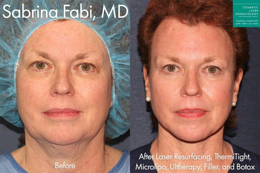 Laser Resurfacing, Micro Lipo, ThermiTight, Ultherapy, Fillers, and Botox for full rejuvenation by Dr. Fabi. Disclaimer: Results may vary from patient to patient. Results are not guaranteed.