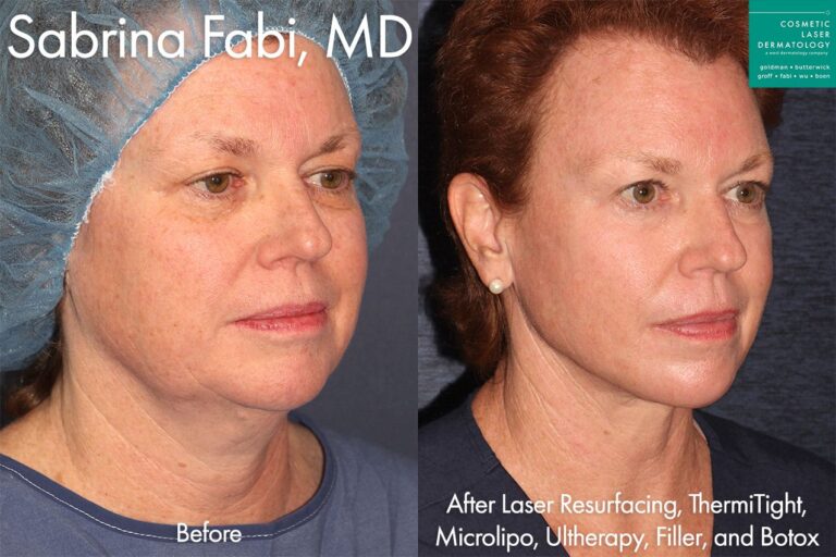 Laser Resurfacing, Micro Lipo, ThermiTight, Ultherapy, Fillers, and Botox for full rejuvenation by Dr. Fabi. Treatment contours jawline, reduces lines and wrinkles, and firms up the skin.