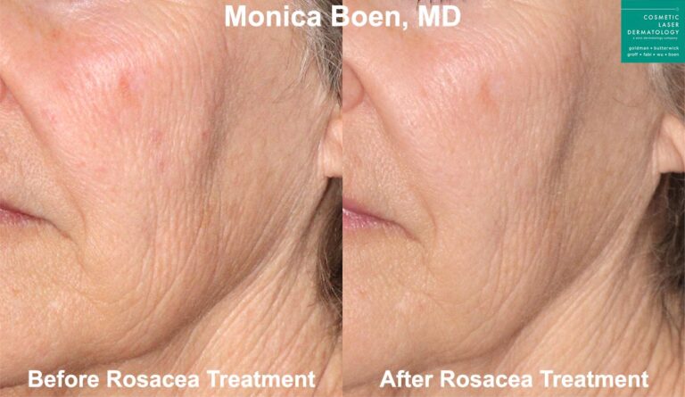Laser treatment for rosacea by Dr. Boen. After treatment, red spots are significantly reduced.