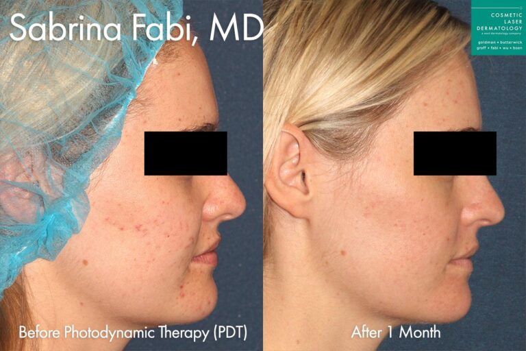 Photodynamic Therapy to treat active acne by Dr. Fabi. One month after treatment, skin is smoother and blemish-free.