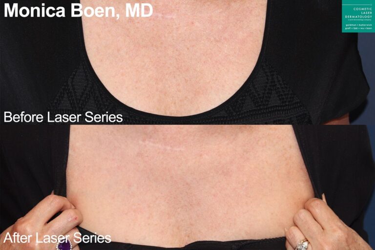 PicoWay Fusion laser to treat sun damage on chest by Dr. Boen. After series of treatments, skin is smoother and clearer.