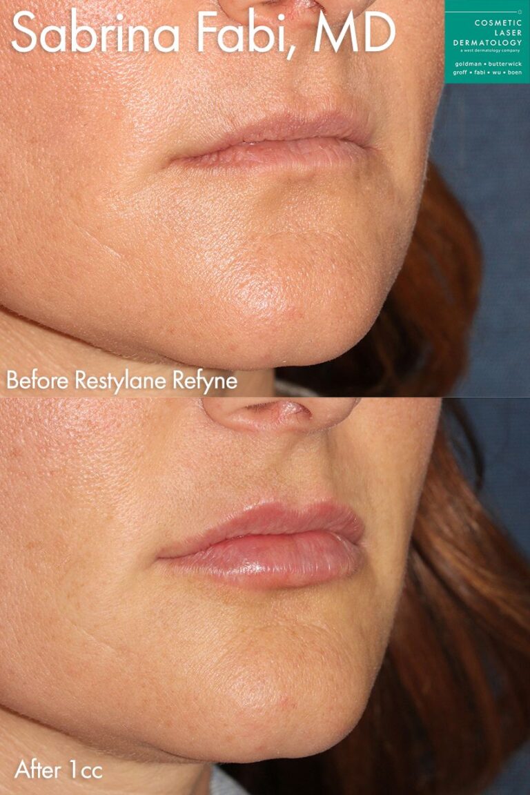 Restylane Refyne for adding shape and fullness to the lips by Dr. Fabi. Treatment creates naturally fuller lips.