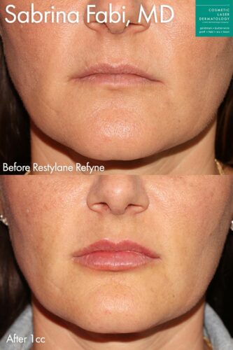 Restylane Refyne for adding shape and fullness to the lips by Dr. Fabi. Treatment creates naturally fuller lips.