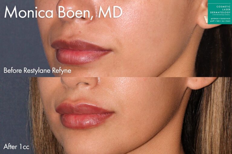 Restylane Refyne to add volume and shape to the lips by Dr. Boen. Treatment creates plumper lips.