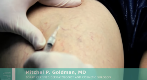 In this image, a series of injections to correct unwanted spider and varicose veins are shown.