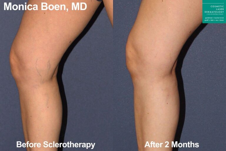 Sclerotherapy to treat visible leg veins by Dr. Boen. After treatment, visible vein next to the knee has disappeared.