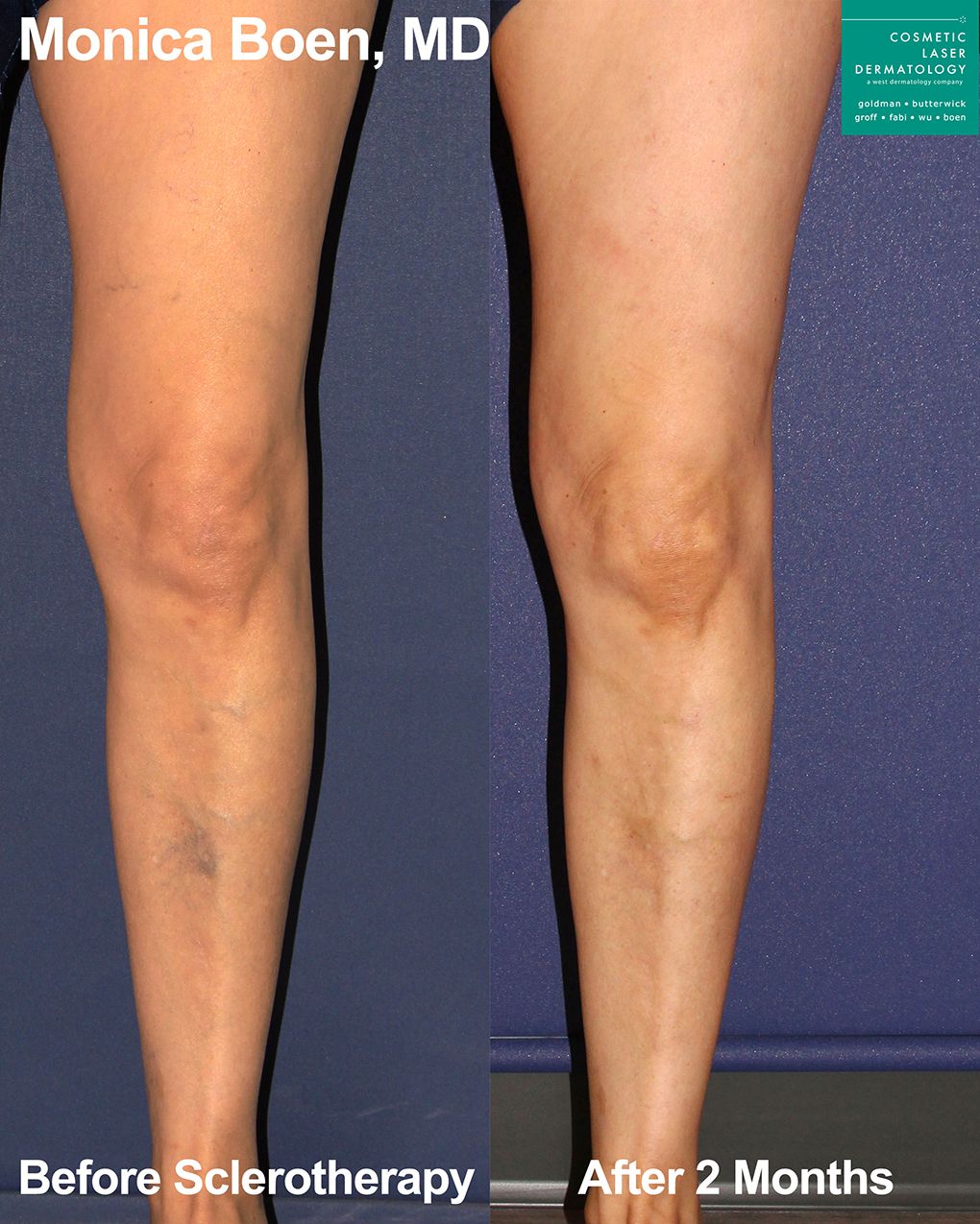 Sclerotherapy to treat visible leg veins by Dr. Boen. After treatment, visible vein on shin has disappeared.