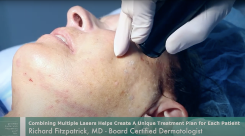 Dr. Fitzpatrick Performs Fraxel Ultra Repair for Sun Damage | Cosmetic Laser Dermatology