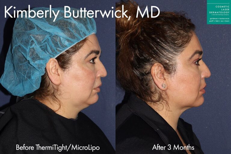 ThermiTight and Micro Liposuction for jawline and neck contouring by Dr. Butterwick. After treatment, double chin is gone and jawline is more defined.
