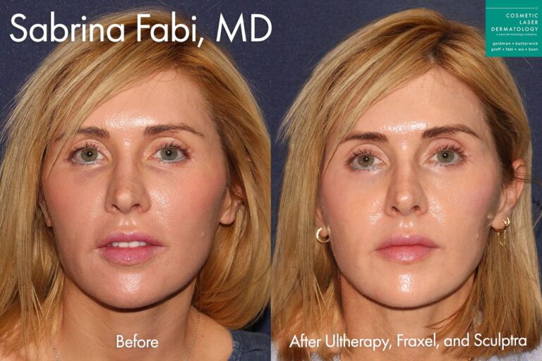 Ultherapy, Fraxel, and Sculptra to tighten and refresh the skin by Dr. Fabi. After treatment, patient's skin is smoother and firmer with more youthful facial contours.