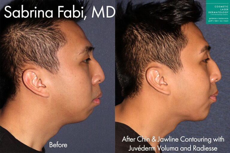 Voluma and Radiesse used to contour the chin and jawline by Dr. Fabi. After treatment, jaw is more defined and chin is more proportionate to other facial features.