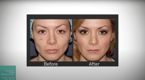 Images before and after voluma a facial filler for a youthful experience, San Diego, CA.