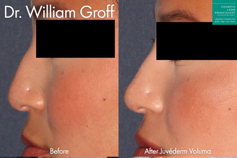 Juvederm Voluma to remove hump from nasal bridge by Dr. Groff. After injections, nasal bridge is straighter and profile is enhanced.