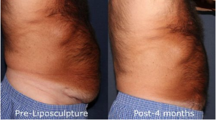 male body contouring treatment results in San Diego, CA