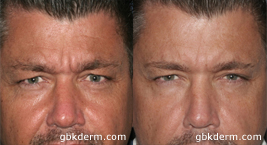 mens botox treatment results in san diego, ca