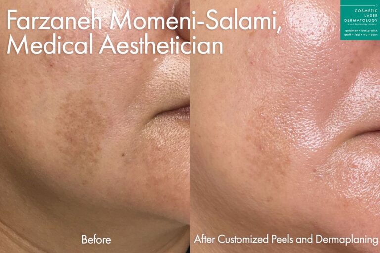 Custom peel to treat melasma on cheek by Farzaneh. After treatment, brown spot is noticeably lighter.