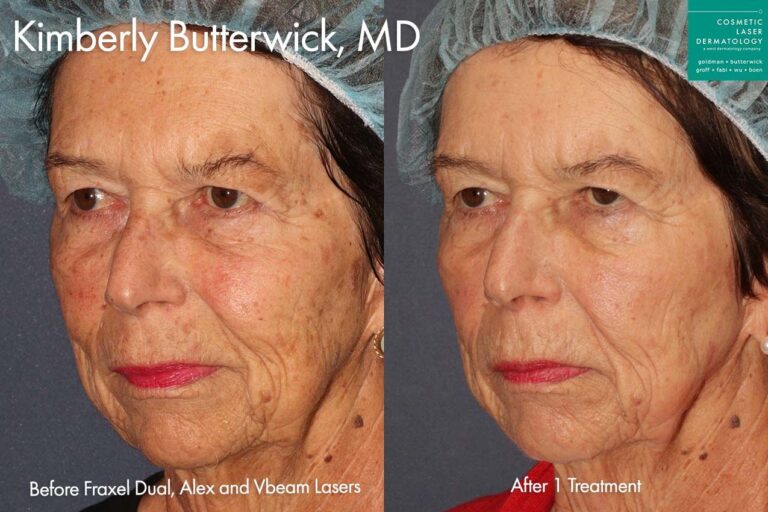 Fraxel, Alexandrite, Vbeam lasers to treat sun damage on face by Dr. Butterwick. After treatment, skin is smoother, clearer, and more youthful looking.