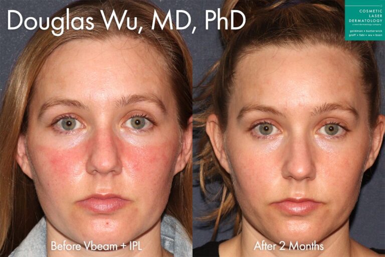 IPL treatment to reduce symptoms of rosacea by Dr. Wu. After treatment, redness around nose and cheeks is minimized.