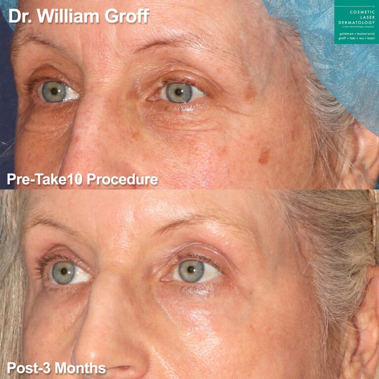 Laser resurfacing to rejuvenate area around the eyes by Dr. Groff. After treatment, skin is smoother with fewer lines around the eyes.
