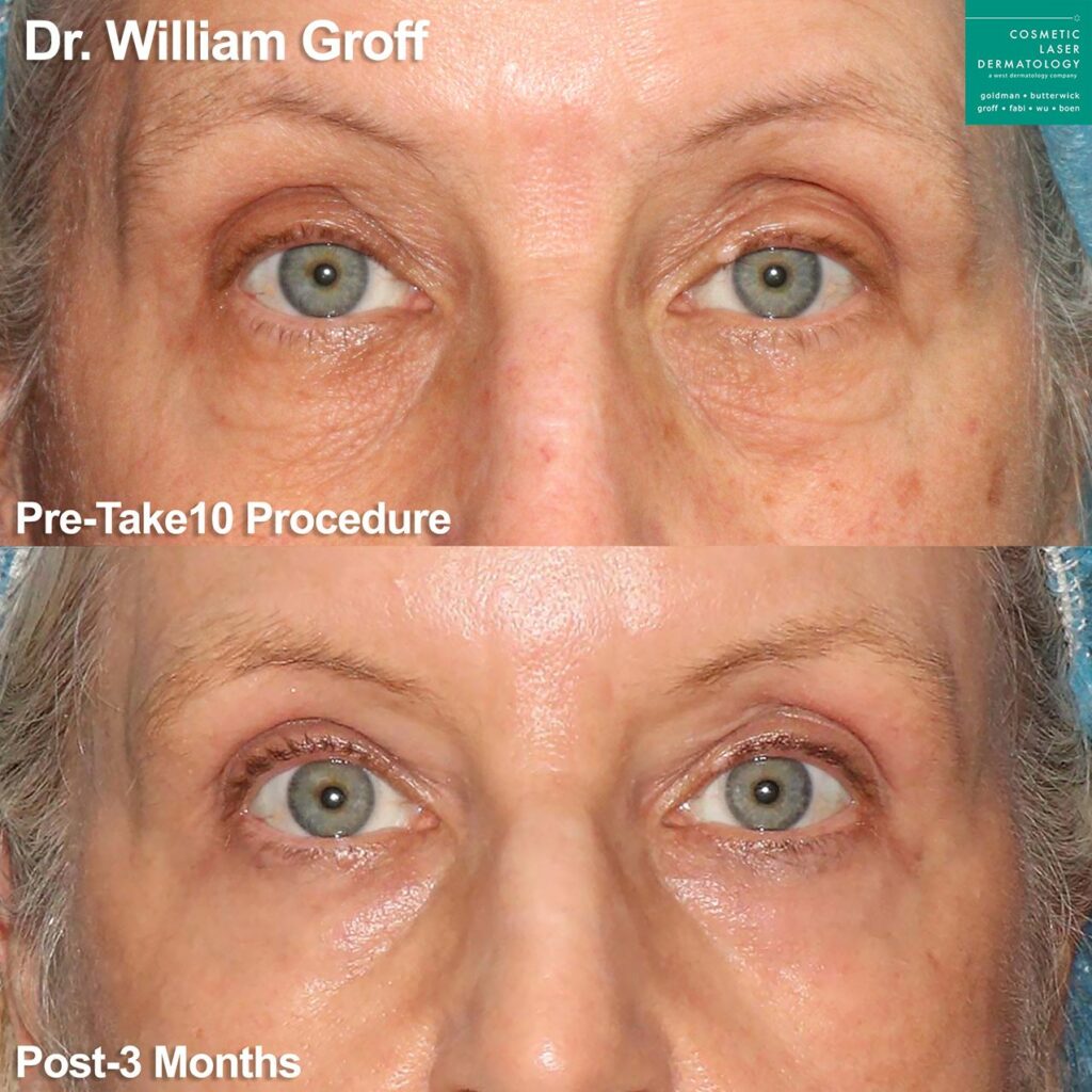 Laser resurfacing to rejuvenate area around the eyes by Dr. Groff. Disclaimer: Results may vary from patient to patient. Results are not guaranteed. 